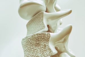 Qué es la osteoporosis