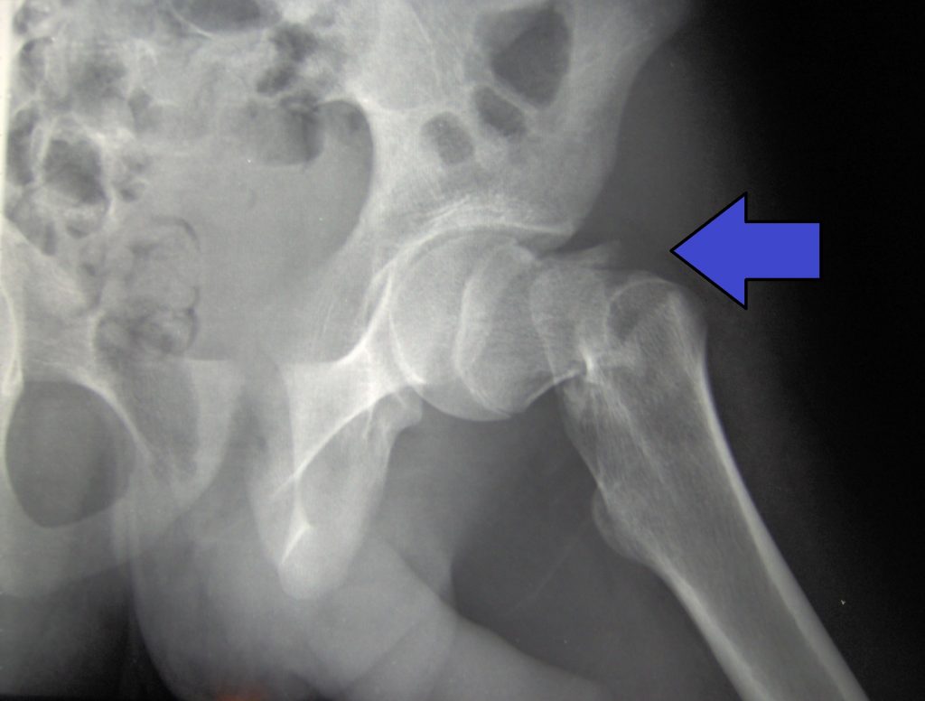 femur