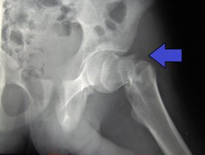 femur