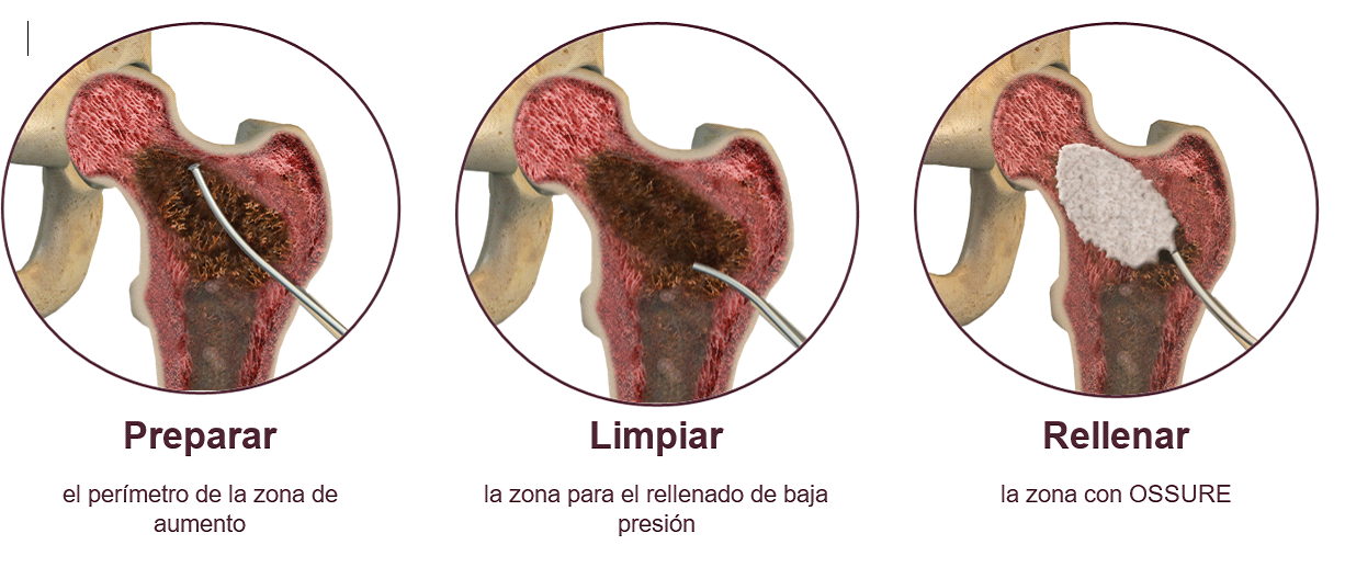 innovación fractura fémur