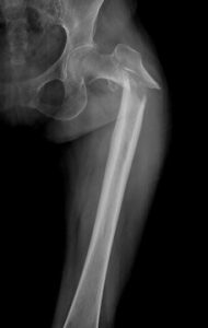 Las innovaciones para evitar fractura del fémur