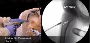 Nueva técnica de Femoroplastia