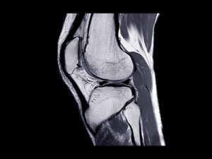 Resultados clínicos de la técnica anteromedial versus la técnica transtibial en la reconstrucción del ligamento cruzado anterior