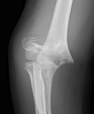 Imágenes 1 y 2: Radiografías AP y Lateral que demuestran una fractura supracondílea de codo derecho.