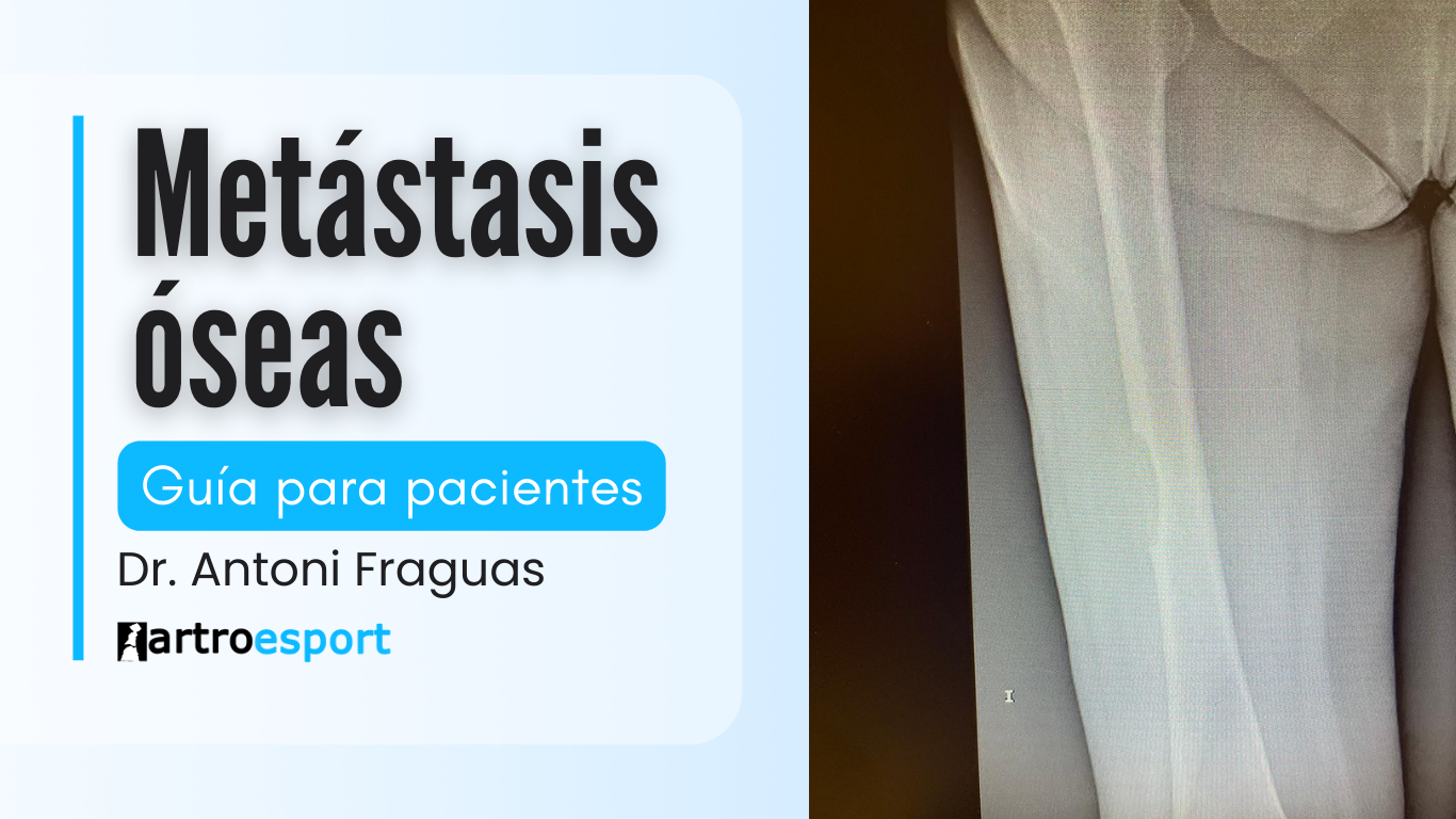 metástasis Óseas dr fraguas