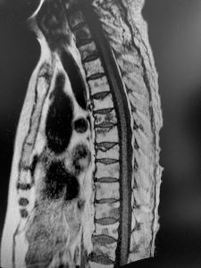 Metástasis vertebrales por melanoma