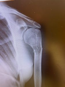 Fractura por metástasis de cáncer de riñón