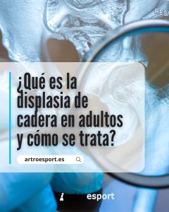 ¿Qué es la displasia de cadera en adultos y cómo se trata